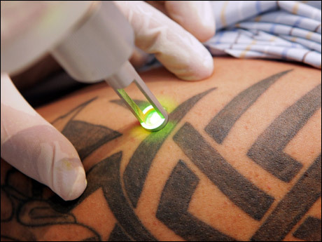 Toronto/GTA's Deal - $49.00 for Laser Tattoo Removal Services from ...